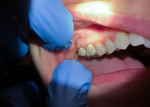 Best Emergency Dentist for Lost Fillings or Crowns in Shillington, PA
